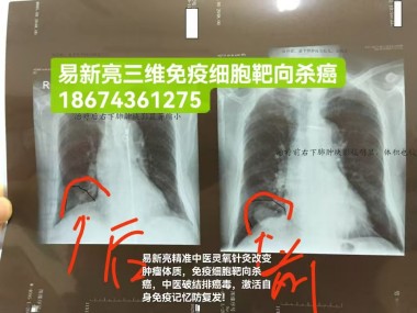 易新亮三维免疫细胞靶向疗法为肿瘤治疗预防癌症复发带来新曙光！