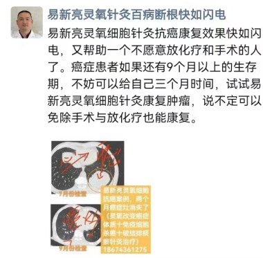 易新亮三维免疫细胞靶向疗法为肿瘤治疗预防癌症复发带来新曙光！